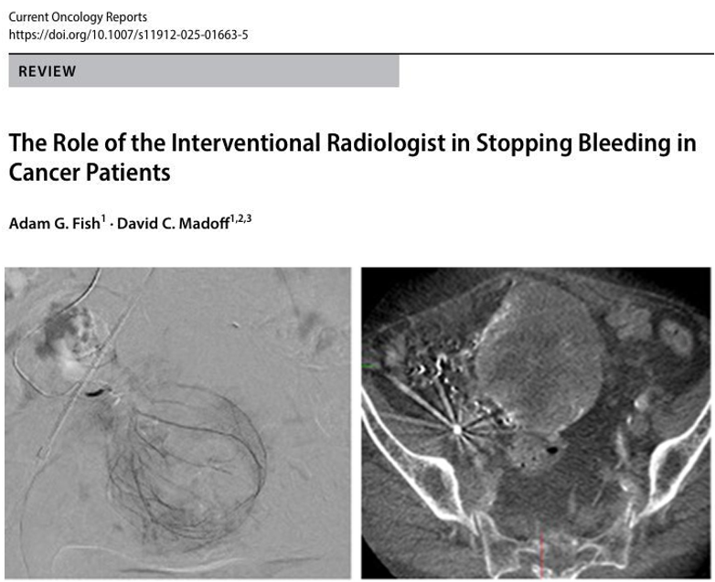 David C. Madoff, MD (@dcmadoff) on Twitter photo Hot off the press in Current Oncology Reports! Dr. <a href="/Adam_G_Fish/">Adam Fish, MD 🇺🇸🇮🇱</a> & I examine the pivotal role of interventional radiology in managing cancer-related bleeding. We discuss endovascular interventions for hemoptysis, hematuria, and GI/gynecologic hemorrhages, emphasizing their Hot off the press in Current Oncology Reports! Dr. <a href="/Adam_G_Fish/">Adam Fish, MD 🇺🇸🇮🇱</a> & I examine the pivotal role of interventional radiology in managing cancer-related bleeding. We discuss endovascular interventions for hemoptysis, hematuria, and GI/gynecologic hemorrhages, emphasizing their