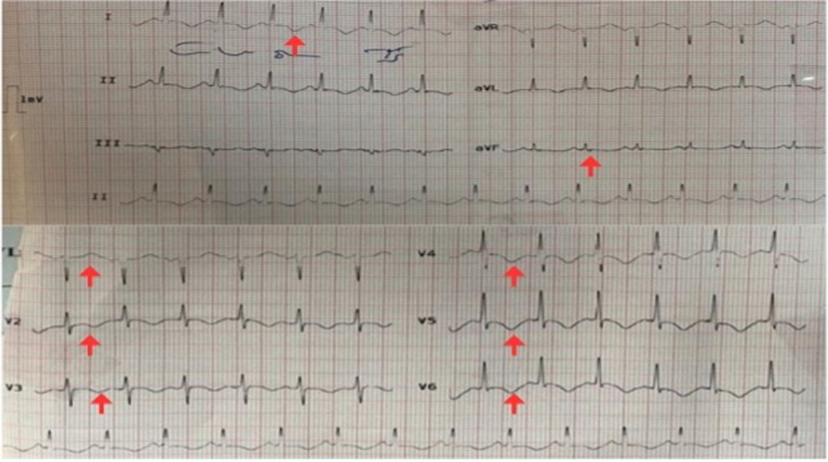 #JACCCaseReports #ACC25 clinical case highlights the necessity for clinicians to be vigilant for #Takotsubo syndrome in patients with acute cardiac conditions, specifically in patients undergoing significant physiological stress.

Get the details: jacc.org/doi/10.1016/j.…