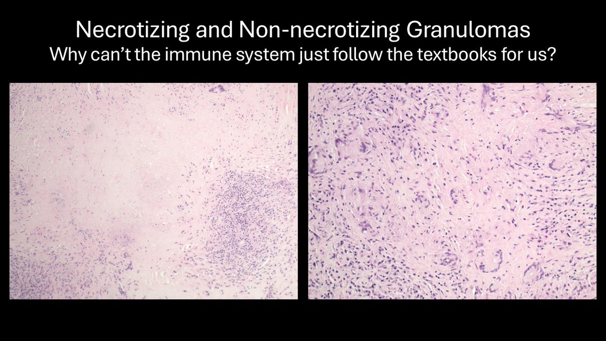 JohnCraigNose's tweet photo. This was just a great case to keep you honest. How often do you think of it? Would be weird if you think of it every time you see this scan, esp when radiologist says it's likely cancer (granted I disagreed). #TissueMatters #Granulomas @henryfordent @ent_ams @N_ChapurinMD @MartaKwiat_ska @MakaryENT