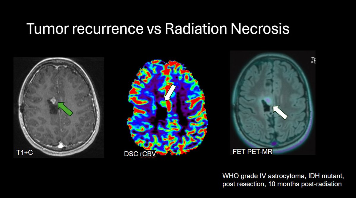American Society of Pediatric Neuroradiology (@the_aspnr) on Twitter photo IPNTN: <a href="/RadRupa/">Rupa Radhakrishnan</a> from <a href="/RileyChildrens/">Riley Children's</a> highlights potential uses for ASL and DSC in pediatric neuroimaging with cases of hemiplegic migraine (ASL) and tumor recurrence (DSC). #IPNTN #PedRad #pedineurorad IPNTN: <a href="/RadRupa/">Rupa Radhakrishnan</a> from <a href="/RileyChildrens/">Riley Children's</a> highlights potential uses for ASL and DSC in pediatric neuroimaging with cases of hemiplegic migraine (ASL) and tumor recurrence (DSC). #IPNTN #PedRad #pedineurorad