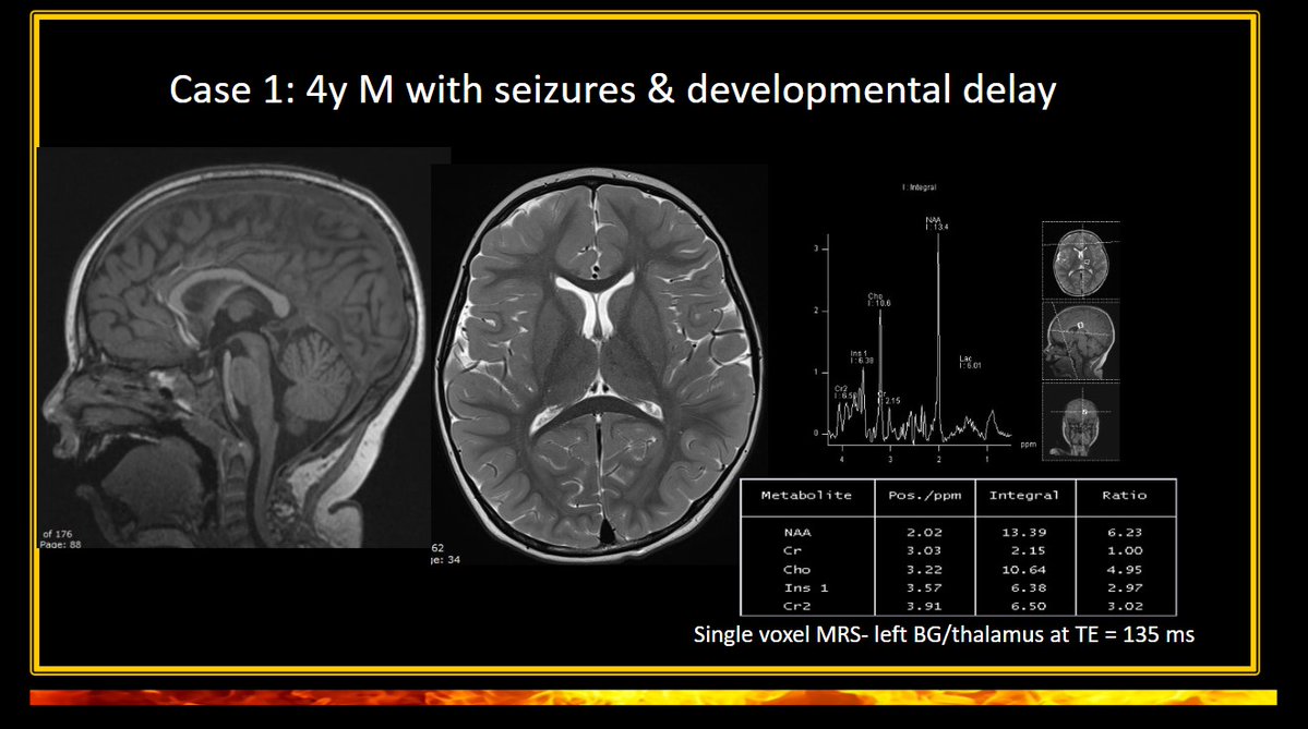American Society of Pediatric Neuroradiology (@the_aspnr) on Twitter photo Here we have <a href="/sanjayprabhu/">Sanjay Prabhu MBBS</a> from <a href="/BostonChildrens/">Boston Children's</a> reviews the how, where, and what for MR spectroscopy through case examples. Remember, an absent Cr peak could be the clue to diagnosing creatinine deficiency. #pedineurorad #IPNTN Here we have <a href="/sanjayprabhu/">Sanjay Prabhu MBBS</a> from <a href="/BostonChildrens/">Boston Children's</a> reviews the how, where, and what for MR spectroscopy through case examples. Remember, an absent Cr peak could be the clue to diagnosing creatinine deficiency. #pedineurorad #IPNTN
