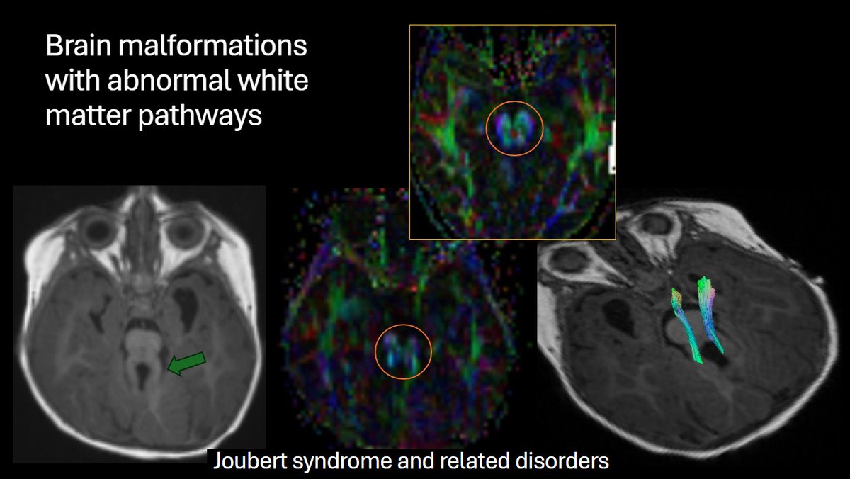 American Society of Pediatric Neuroradiology (@the_aspnr) on Twitter photo IPNTN: <a href="/RadRupa/">Rupa Radhakrishnan</a> from <a href="/RileyChildrens/">Riley Children's</a> shows potential role for DTI in mapping eloquent brain for surgical planning and assessing corpus callosotomy. DTI also helpful in Joubert related disorders (look for missing superior cerebellar decussation- red dot). #pedineurorad IPNTN: <a href="/RadRupa/">Rupa Radhakrishnan</a> from <a href="/RileyChildrens/">Riley Children's</a> shows potential role for DTI in mapping eloquent brain for surgical planning and assessing corpus callosotomy. DTI also helpful in Joubert related disorders (look for missing superior cerebellar decussation- red dot). #pedineurorad