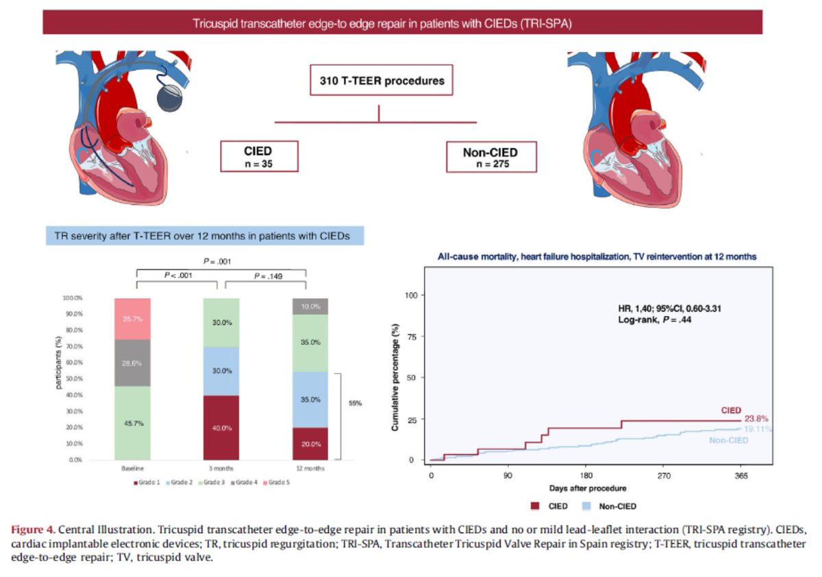 Juan Sanchis (@juansanchisfor) on Twitter photo Effectiveness and clinical outcomes of tricuspid transcatheter edge-to-edge repair in patients with cardiac implantable electronic devices. Read this article published in <a href="/RevEspCardiol/">REC Publications</a> by <a href="/freixa_xavier/">Xavier Freixa</a> <a href="/a_rubi_5/">Andrea Ruberti</a> <a href="/pedro_cepas/">Pedro Cepas</a> <a href="/lsanchisruiz/">Laura Sanchis</a> <a href="/ejfu0209/">Eduardo Flores-Umanzor</a>. revespcardiol.org/en-efficacy-of… Effectiveness and clinical outcomes of tricuspid transcatheter edge-to-edge repair in patients with cardiac implantable electronic devices. Read this article published in <a href="/RevEspCardiol/">REC Publications</a> by <a href="/freixa_xavier/">Xavier Freixa</a> <a href="/a_rubi_5/">Andrea Ruberti</a> <a href="/pedro_cepas/">Pedro Cepas</a> <a href="/lsanchisruiz/">Laura Sanchis</a> <a href="/ejfu0209/">Eduardo Flores-Umanzor</a>. revespcardiol.org/en-efficacy-of…