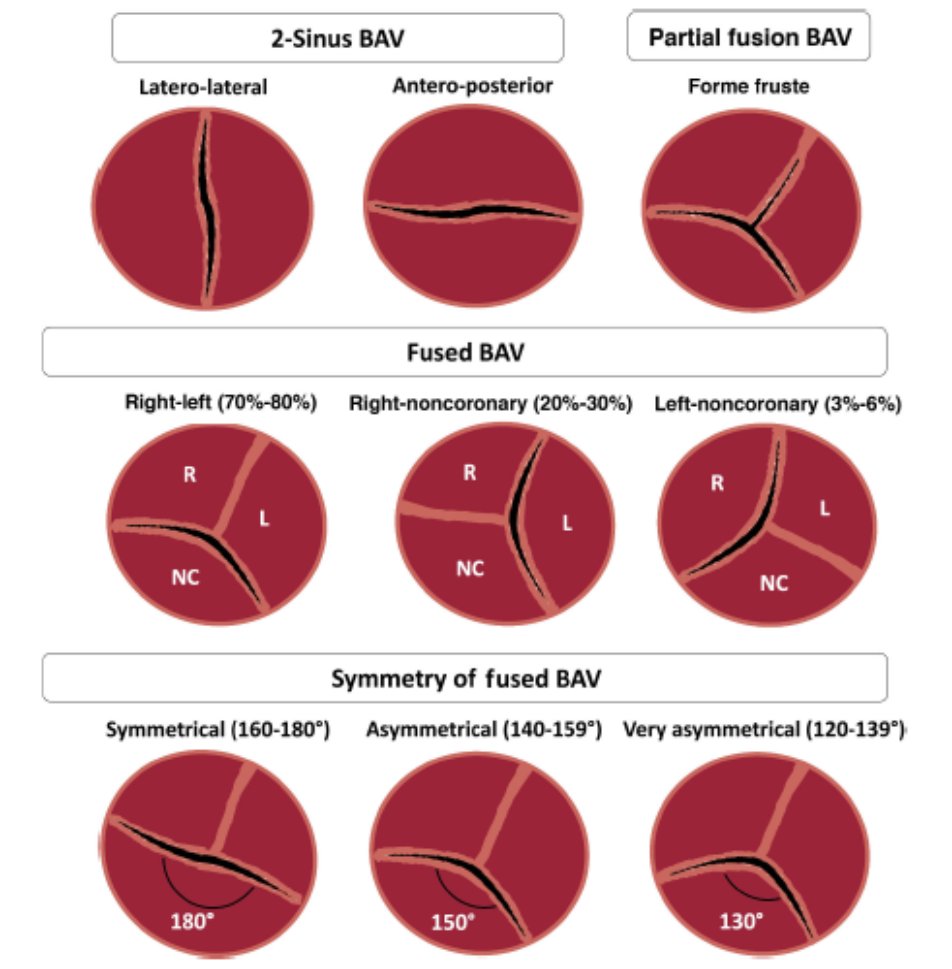 Juan Sanchis (@juansanchisfor) on Twitter photo Transcatheter aortic valve implantation in bicuspid aortic valves: present and future. Read this review published in <a href="/RevEspCardiol/">REC Publications</a> by <a href="/HUCA_Asturias/">@HUCA</a> <a href="/PabloAvanzas/">Pablo Avanzas</a> <a href="/shci_sec/">ACI-SEC: Hemodinamica</a>. revespcardiol.org/en-transcathet… Transcatheter aortic valve implantation in bicuspid aortic valves: present and future. Read this review published in <a href="/RevEspCardiol/">REC Publications</a> by <a href="/HUCA_Asturias/">@HUCA</a> <a href="/PabloAvanzas/">Pablo Avanzas</a> <a href="/shci_sec/">ACI-SEC: Hemodinamica</a>. revespcardiol.org/en-transcathet…