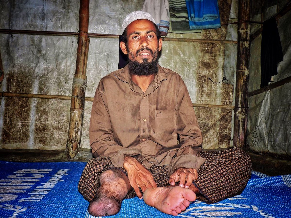 Rohingyatographer Magazine (@rohingyamakzin) on Twitter photo Noor Kalim, 36, a Rohingya man from Foyazipara village in Maungdaw township, Arakan state, 🇲🇲, is a survivor of genocide. He and his family have endured unimaginable horrors at the hands of both the Burmese military (Junta) and the so-called Arakan Army (AA).
📷 <a href="/ayubkhan_dkl/">Ayub Khan DKL</a> Noor Kalim, 36, a Rohingya man from Foyazipara village in Maungdaw township, Arakan state, 🇲🇲, is a survivor of genocide. He and his family have endured unimaginable horrors at the hands of both the Burmese military (Junta) and the so-called Arakan Army (AA).
📷 <a href="/ayubkhan_dkl/">Ayub Khan DKL</a>