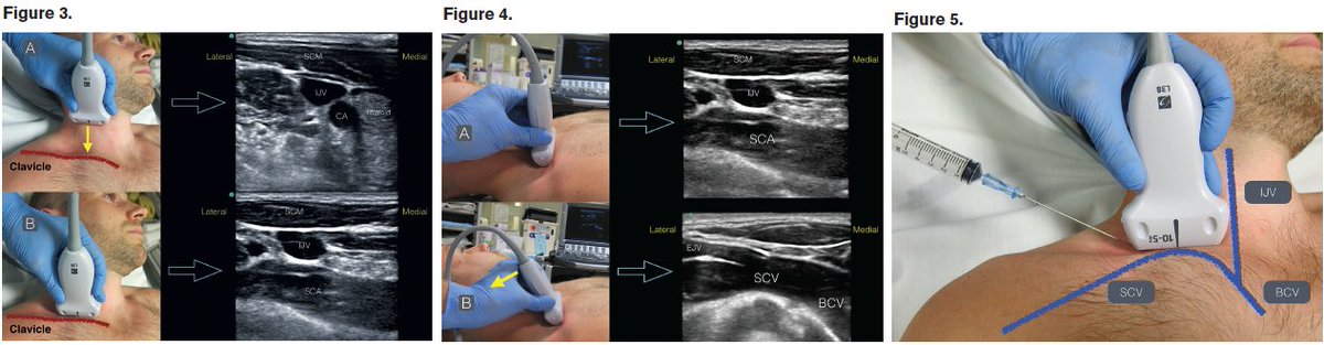 NephroPOCUS (@nephrop) on Twitter photo Using the Supraclavicular Approach to Ultrasound-Guided Subclavian Vein Cannulation.
#POCUS #FOAMed #FOAMcc 
What’s your preferred approach for subclavian cannulation?
🔗 acepnow.com/article/using-… Using the Supraclavicular Approach to Ultrasound-Guided Subclavian Vein Cannulation.
#POCUS #FOAMed #FOAMcc 
What’s your preferred approach for subclavian cannulation?
🔗 acepnow.com/article/using-…