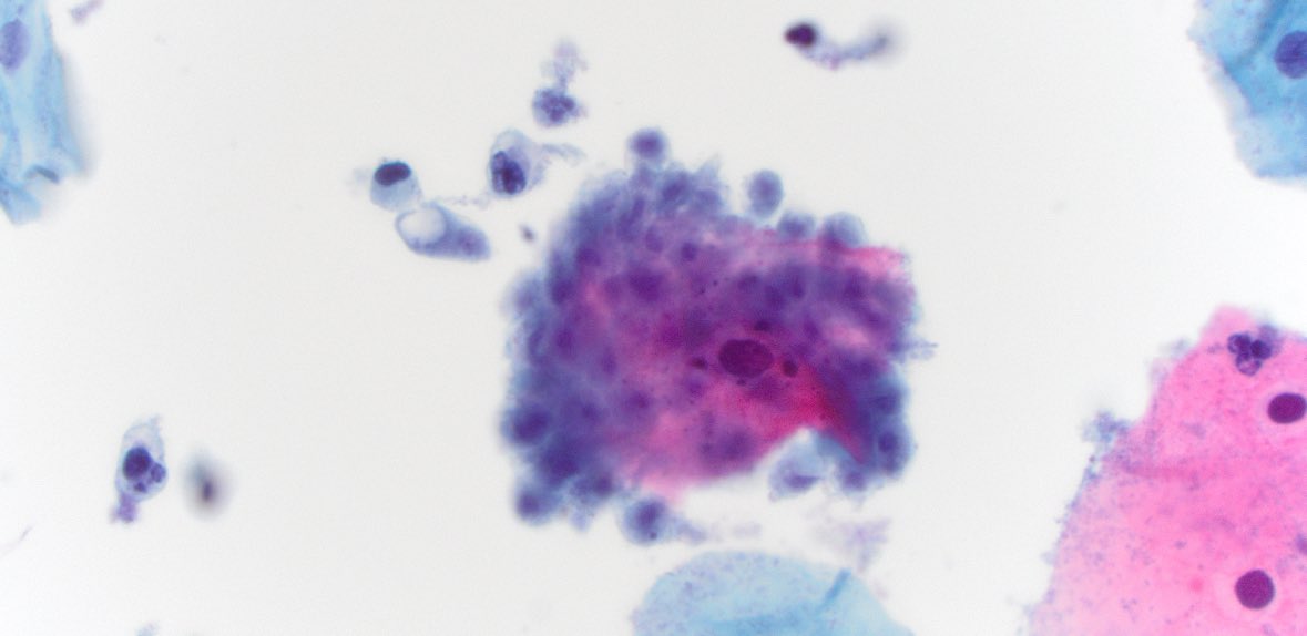 Terri Jones, MD, FASCP (@tewajonesmd) on Twitter photo Sometimes it’s not good to be popular…
What sort of “party” is this? #PathTwitter <a href="/UPMCPathology/">UPMC Pathology</a> #cytology Sometimes it’s not good to be popular…
What sort of “party” is this? #PathTwitter <a href="/UPMCPathology/">UPMC Pathology</a> #cytology