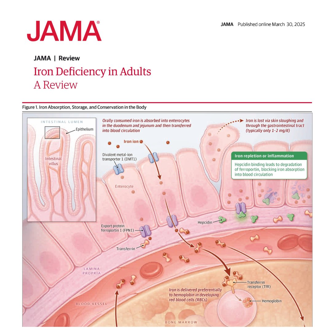 JAMAInternalMed's tweet photo. From @JAMA_current: Absolute iron deficiency affects approximately 2 billion people worldwide. 

This narrative review examines the screening, diagnosis, and treatment of adults w/ absolute iron deficiency w/o anemia and iron-deficiency anemia. 

#ACC25 https://t.co/pnwmvw1gYe https://t.co/6h8ddCoc8K