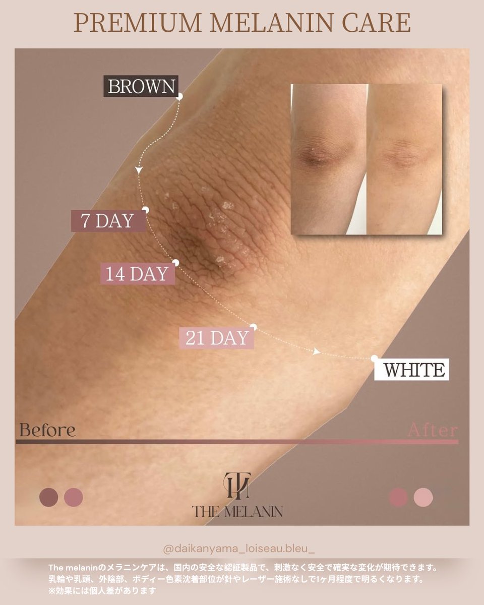 メラニンケア導入しました🌸中国製メーカーのアフタークリームが合わ