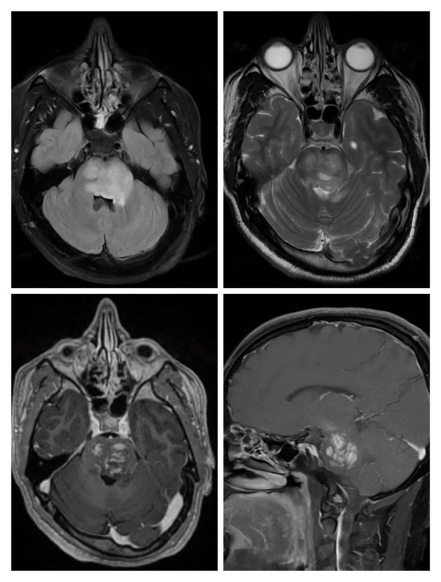 doc_tks_rad's tweet image. Chronic lymphocytic inflammation with pontine perivascular enhancement responsive to steroids (CLIPPERS)
As the name suggests characterized by multiple punctate, patchy and linear areas of enhancement in the pons and typically respond well to steroids✅
#FOAMrad #neurotwitter
