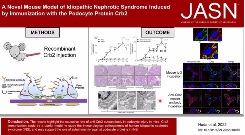Izabela Zakrocka (@izabelazakrocka) on Twitter photo Sunday = glom funday ✨excellent talk of Dr Renke about podocytopathies with wonderful guests <a href="/SethiRenalPath/">Sanjeev Sethi</a> <a href="/GlassockJ/">Richard J. Glassock</a> <a href="/Tiff_Caza/">Tiffany Caza</a> <a href="/BajinderR/">bajinder reen</a> <a href="/ldcornell/">Lynn D. Cornell, M.D.</a> <a href="/GlomCon/">GlomCon</a> <a href="/AstridWeins/">Astrid Weins</a> Sunday = glom funday ✨excellent talk of Dr Renke about podocytopathies with wonderful guests <a href="/SethiRenalPath/">Sanjeev Sethi</a> <a href="/GlassockJ/">Richard J. Glassock</a> <a href="/Tiff_Caza/">Tiffany Caza</a> <a href="/BajinderR/">bajinder reen</a> <a href="/ldcornell/">Lynn D. Cornell, M.D.</a> <a href="/GlomCon/">GlomCon</a> <a href="/AstridWeins/">Astrid Weins</a>