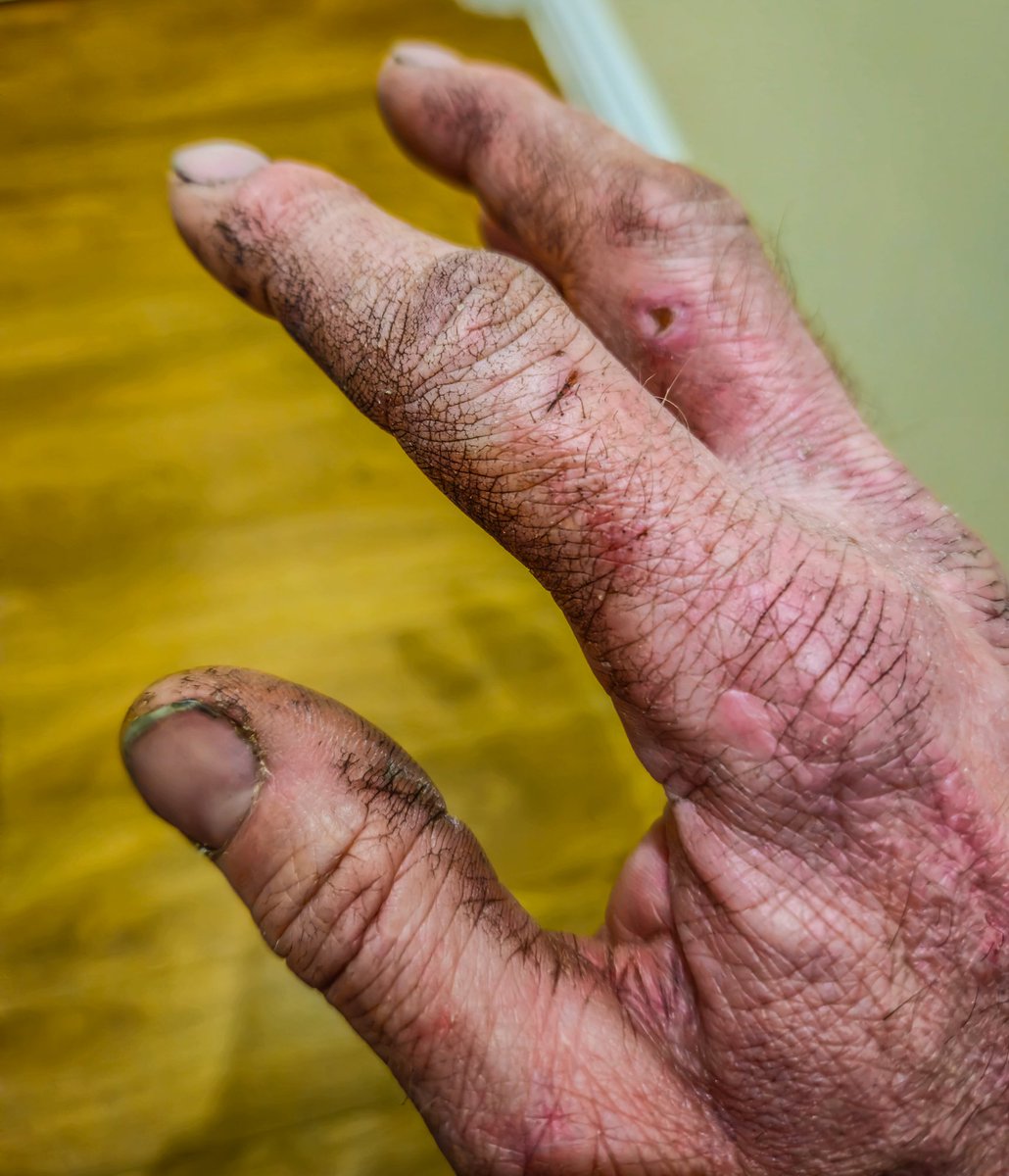 It's been 4 days since I did the job at work that in this state and their about as clean as their going to get.
Can't scrub them too much as not a lot of skin left on them now 😕
#mechanicshands