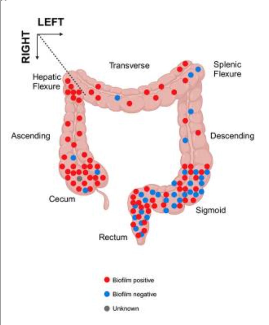 Susan Bullman (@bullmanlab) on Twitter photo Beautiful work on Fusobacterium and CRC by <a href="/JessicaRQueen1/">Jessica Queen, MD PhD</a>, Drewes & Sears teams. “Biofilms were prevalent on colon tumors visualized in 68.8% ….more frequently observed on right-sided tumors (91.7%)”.
biorxiv.org/content/10.110… Beautiful work on Fusobacterium and CRC by <a href="/JessicaRQueen1/">Jessica Queen, MD PhD</a>, Drewes & Sears teams. “Biofilms were prevalent on colon tumors visualized in 68.8% ….more frequently observed on right-sided tumors (91.7%)”.
biorxiv.org/content/10.110…