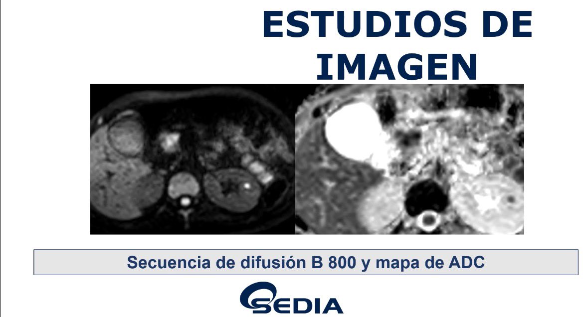 sediabdomen's tweet photo. Ya está disponible el #casosedia de marzo
“Chica de 29 caños con dolor epigástrico. AP de úlcera gástrica. Se piden pruebas de imagen para descartar perforación”
¿Cuál es tu diagnóstico?
Manda tu respuesta a info@sedia.es y consigue una inscripción para #XXVcongresosedia https://t.co/UXsqvBHE1Y