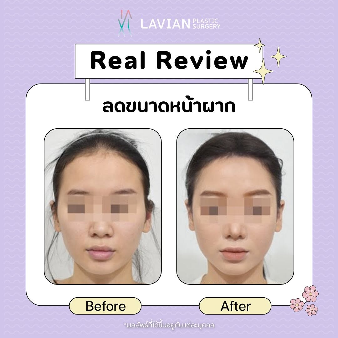 stmstyle_'s tweet photo. 🎀 บอกลาปัญหาหน้าผากกว้าง ทำให้หน้าดูใหญ่!
ด้วยการลดขนาดหน้าผาก ✨ย้อนวัยผมหนา ดูลดอายุได้ 😍

ปรึกษาฟรี! Line Official: https://t.co/z0nCYcwy5u 

#รีวิวศัลยกรรม #ศัลยกรรม #รีวิวเกาหลี #ลดขนาดหน้าผาก https://t.co/dlRYKjjmmH