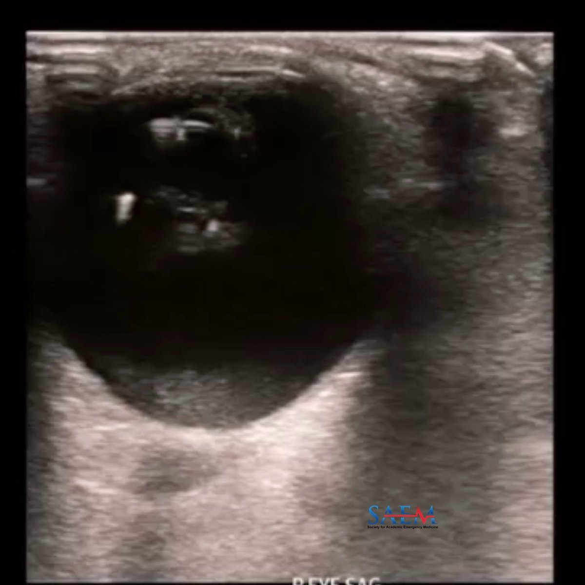 SAEM Clinical Images Series: Case of Painless Vision Changes

Can you identify the chambers? Iris? Ciliary body? 

aliem.com/saem-clinical-…

<a href="/SAEMonline/">SAEM</a>