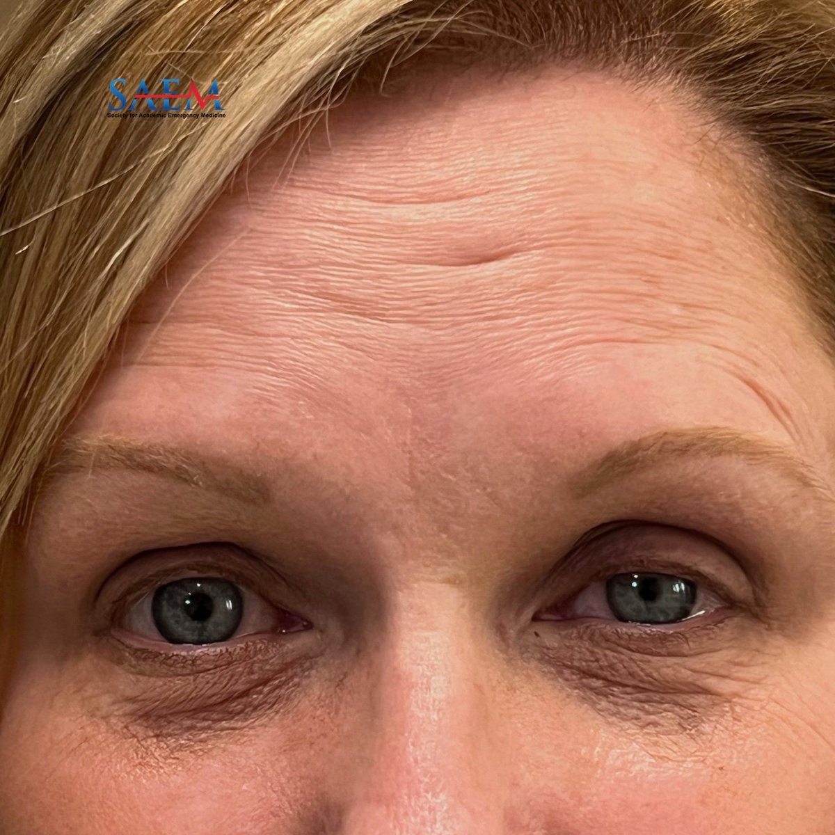 SAEM Clinical Images Series: Ptosis? A Don't Miss Diagnosis!

What's your differential for this finding?

aliem.com/saem-clinical-…

<a href="/SAEMonline/">SAEM</a>