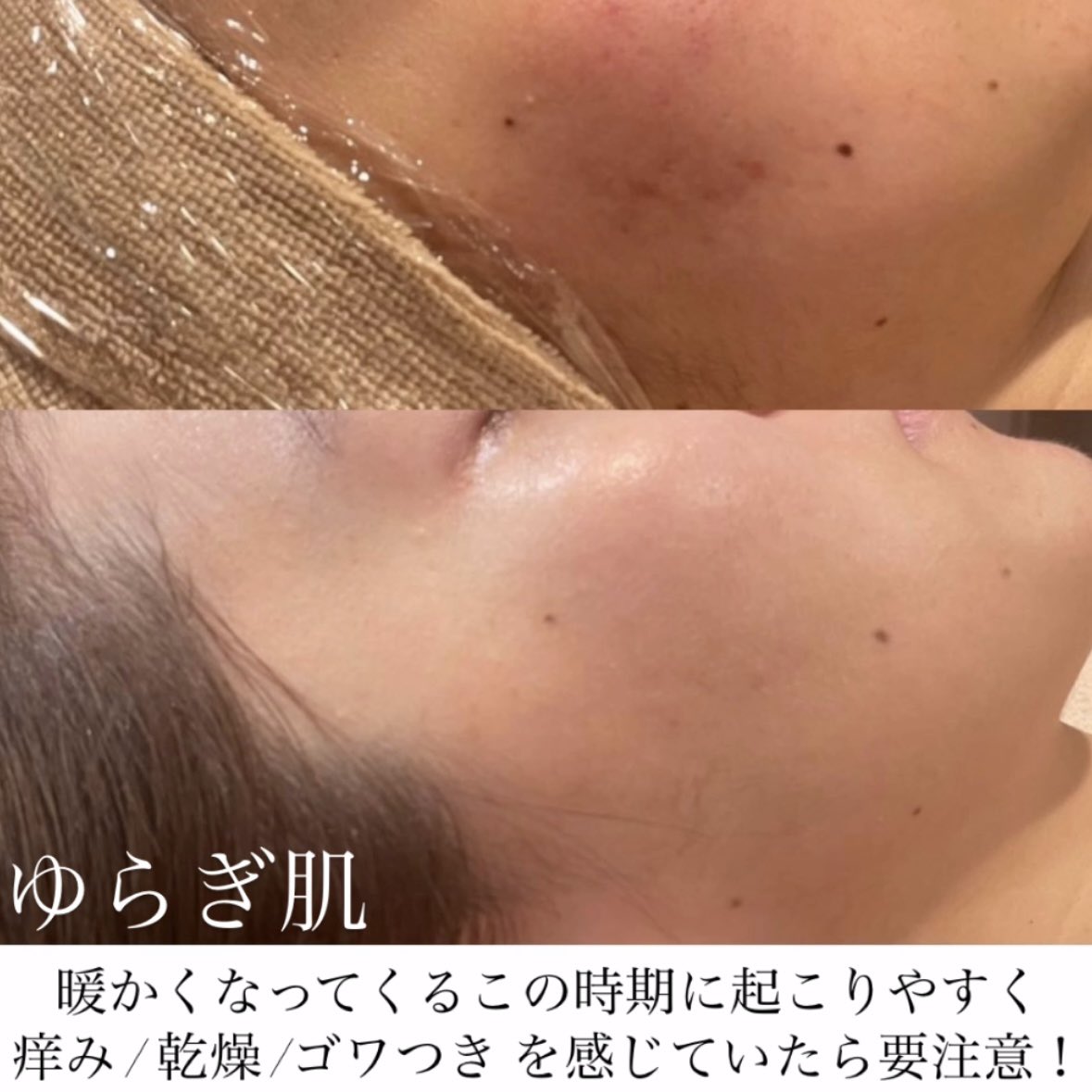 Luve_mlc's tweet photo. 乾燥/ゴワつき/痒み/赤み/ニキビ/体のだるさ

当てはまるお悩みありませんか？
季節による気圧や温度の変化で
お肌がゆらぎやすくなっています💦

そのまま放っておくと
もっとお悩みが悪化するかも！？

肌の育成&amp;細胞ケア
これがお悩み改善のキーポイントです！

陶肌ハーブピーリングで肌活を☺️💫 https://t.co/NSRCzNPmfC