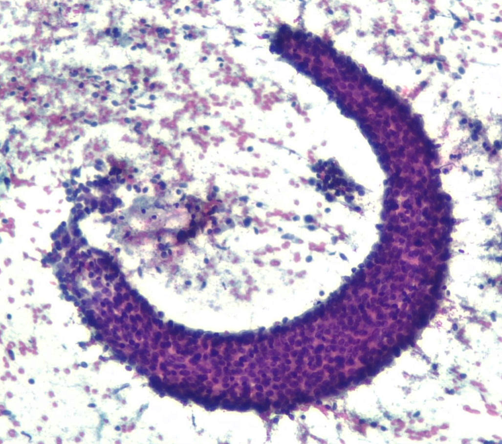 Lola Lozano (@mdlozanoe) on Twitter photo "Moon-shaped fibroadenoma"
Wishing everyone a happy and blessed week, (whether you read this tweet or not )🌙🕊️🙌🌎🌍🌏#Cytopath #pathology <a href="/IACytology/">International Academy Cytology</a> <a href="/PapSociety/">Papanicolaou Society</a> <a href="/SECitologia/">Sociedad Española de Citología</a> <a href="/SEAP_IAP/">SEAP-IAP</a> <a href="/cytopathology/">Cytopathology.org</a> <a href="/ESP_Pathology/">European Society of Pathology (ESP)</a> <a href="/pathologistmag/">The Pathologist</a> <a href="/israhkhan/">Israh Akhtar Khan</a> <a href="/KMirza/">Kamran Mirza MD PhD - کامران مرزا</a> <a href="/aakasharmand/">Zubair Baloch</a> <a href="/mtsiddi/">Momin Siddiqui</a> "Moon-shaped fibroadenoma"
Wishing everyone a happy and blessed week, (whether you read this tweet or not )🌙🕊️🙌🌎🌍🌏#Cytopath #pathology <a href="/IACytology/">International Academy Cytology</a> <a href="/PapSociety/">Papanicolaou Society</a> <a href="/SECitologia/">Sociedad Española de Citología</a> <a href="/SEAP_IAP/">SEAP-IAP</a> <a href="/cytopathology/">Cytopathology.org</a> <a href="/ESP_Pathology/">European Society of Pathology (ESP)</a> <a href="/pathologistmag/">The Pathologist</a> <a href="/israhkhan/">Israh Akhtar Khan</a> <a href="/KMirza/">Kamran Mirza MD PhD - کامران مرزا</a> <a href="/aakasharmand/">Zubair Baloch</a> <a href="/mtsiddi/">Momin Siddiqui</a>