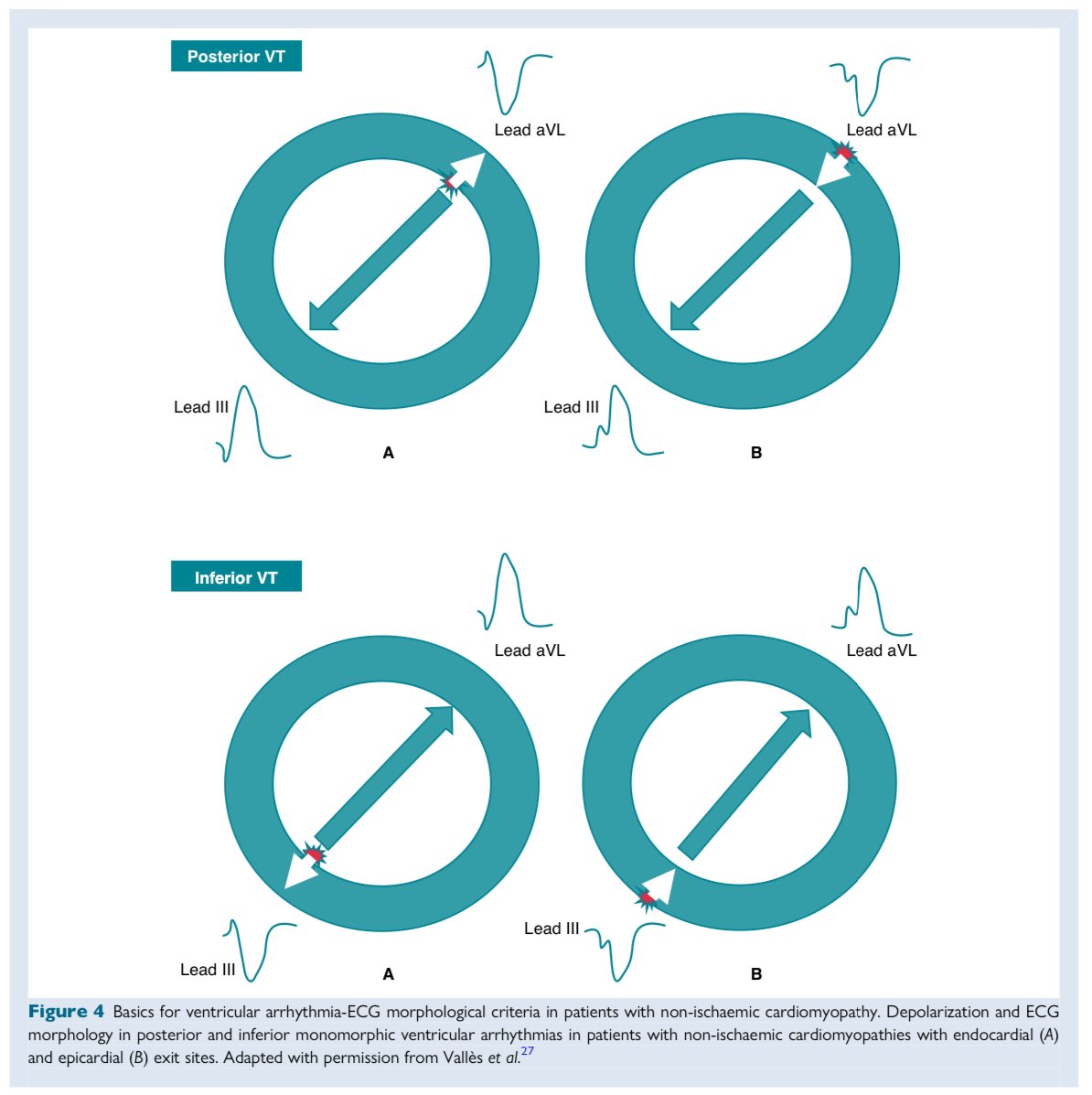 Europace Editor-in-Chief (@europaceeic) on Twitter photo 📣Epicardial VAs Ablation ⚡️🎯
🌎A Clinical Consensus Statement of the EHRA/HRS/APHRS/LAHRS/CHRS
#Europace <a href="/escardio/">European Society of Cardiology</a>
🔗 academic.oup.com/europace/artic…
✅ Anatomical considerations
✅ Epicardial access & mapping
✅ Procedural methods & complications
✅ Institutional requirements 📣Epicardial VAs Ablation ⚡️🎯
🌎A Clinical Consensus Statement of the EHRA/HRS/APHRS/LAHRS/CHRS
#Europace <a href="/escardio/">European Society of Cardiology</a>
🔗 academic.oup.com/europace/artic…
✅ Anatomical considerations
✅ Epicardial access & mapping
✅ Procedural methods & complications
✅ Institutional requirements