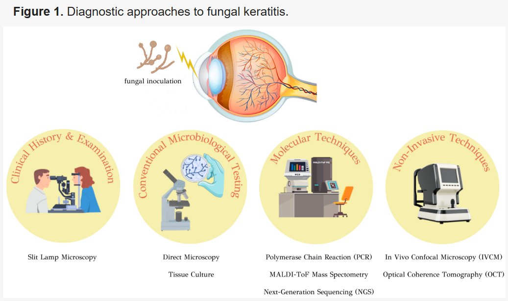 JCM_MDPI's tweet image. #mdpijcm
#Feature_Paper
From Clinical Suspicion to Diagnosis: A Review of Diagnostic Approaches and Challenges in Fungal #Keratitis
Views 3399, Citations 5👏 @MediPharma_MDPI
👉mdpi.com/2626052