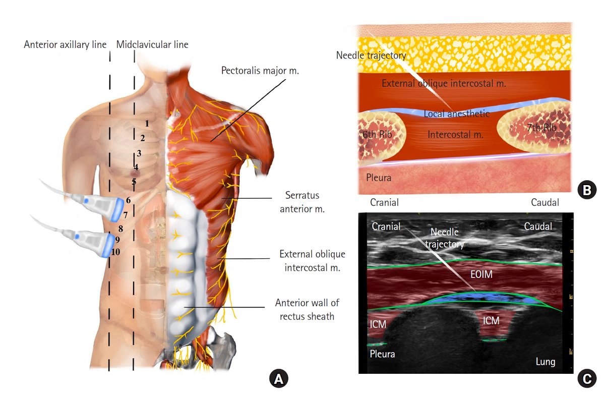 Korean Journal of Anesthesiology (KJA) (@korean_j_anesth) on Twitter photo Managing postoperative pain in bariatric surgery is challenging. Can external oblique intercostal block  improve outcomes? Our study shows significant opioid reduction and better recovery in obese patients undergoing laparoscopic sleeve gastrectomy! 
doi.org/10.4097/kja.24… Managing postoperative pain in bariatric surgery is challenging. Can external oblique intercostal block  improve outcomes? Our study shows significant opioid reduction and better recovery in obese patients undergoing laparoscopic sleeve gastrectomy! 
doi.org/10.4097/kja.24…