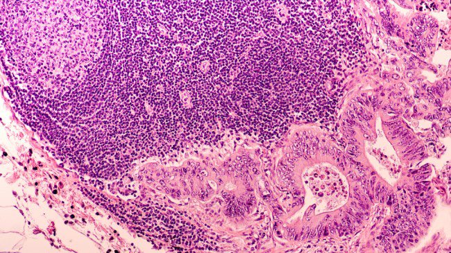UofG News (@uofgnews) on Twitter photo .<a href="/UofGlasgow/">University of Glasgow</a> researchers are among the team of European clinicians and scientists who form CRC-STARS, a world-leading research team tasked with making personalised medicine a reality for people with bowel cancer.
<a href="/CRUKresearch/">Science and Innovation at Cancer Research UK</a> <a href="/BowelbabeF/">The Bowelbabe Fund</a> <a href="/UofGMVLS/">UofG MVLS</a>
➡️ gla.ac/3FOssTf .<a href="/UofGlasgow/">University of Glasgow</a> researchers are among the team of European clinicians and scientists who form CRC-STARS, a world-leading research team tasked with making personalised medicine a reality for people with bowel cancer.
<a href="/CRUKresearch/">Science and Innovation at Cancer Research UK</a> <a href="/BowelbabeF/">The Bowelbabe Fund</a> <a href="/UofGMVLS/">UofG MVLS</a>
➡️ gla.ac/3FOssTf