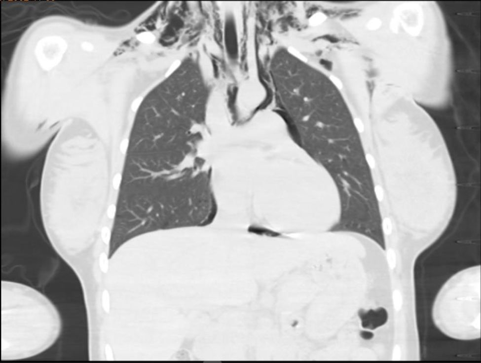 Pneumomediastinum radiologic signs: Naclerio's V and continuous diaphragm sign. medintensiva.org/es-pneumomedia…