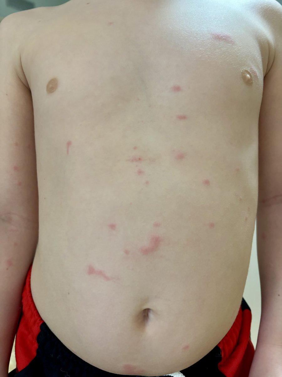 allobe86's tweet photo. Niño de 5 años que acude por lesiones pruriginosas de 36h de evolución en abdomen.Ha estado jugando con maderas y arena.Las lesiones son fijas.

¿Diagnóstico clínico probable?

@aepediatria @pielsana_aedv @aepap @ContinuumAEP #MIR2026 @2PediatrasNCasa @luciapediatra @daandina https://t.co/uP9cF00wz9