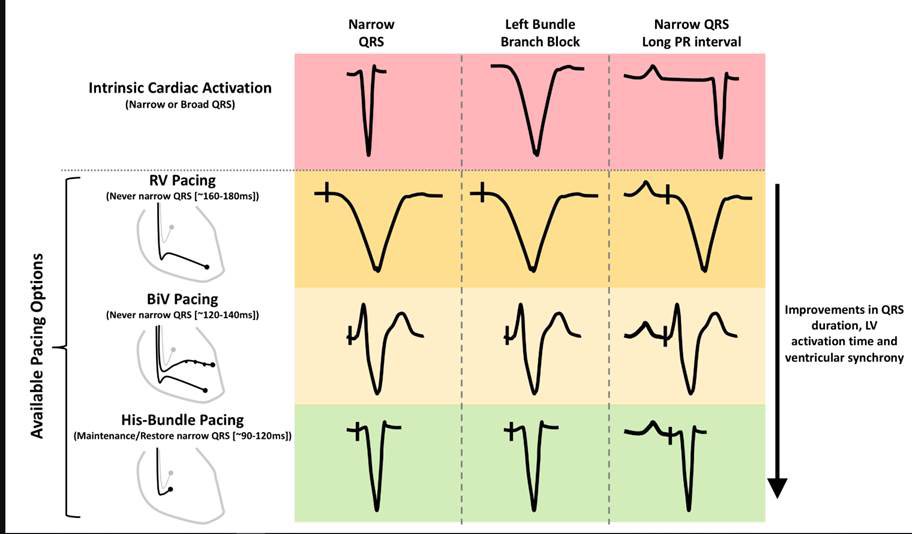 Different pacing modalities #ecg