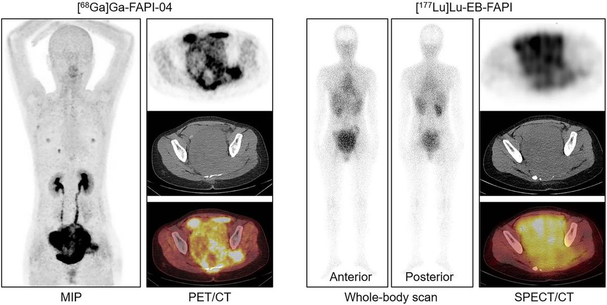 ⁶⁸Ga-FAPI-04 PET/CT may be a more accurate PET tracer for diagnosing and staging solitary fibrous tumors than ¹⁸F-FDG, with a higher detection rate and tumor uptake in most organs involved. ow.ly/guGl50VjuKG

#NuclearMedicine #PETscan #RPTherapy #Sarcoma
