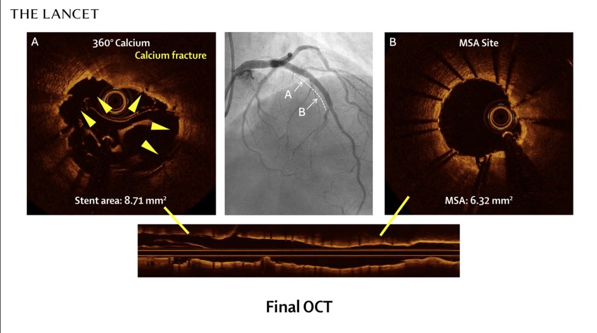 MIЯVΛƬ #IC (@mirvatalasnag) on Twitter photo #ACC25 <a href="/PCRonline/">PCRonline 🫀</a>
⚒️Eclipse Trial concludes that for crossable lesions a balloon based modification strategy guided by imaging should be the default.
⚒️So for uncrossable lesions, orbital, rotational or laser atherectomy remain useful tools.
⚒️ A video appendix provides #ACC25 <a href="/PCRonline/">PCRonline 🫀</a>
⚒️Eclipse Trial concludes that for crossable lesions a balloon based modification strategy guided by imaging should be the default.
⚒️So for uncrossable lesions, orbital, rotational or laser atherectomy remain useful tools.
⚒️ A video appendix provides