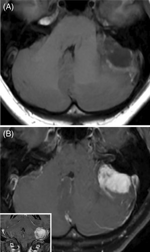 brainpathol's tweet image. A 23-year-old woman with a headache and imbalance
WHAT IS YOUR DIAGNOSIS?
WSI: isn-slidearchive.org/?col=ISN&fol=A…
Case discussion: onlinelibrary.wiley.com/doi/10.1111/bp…
#neuropath