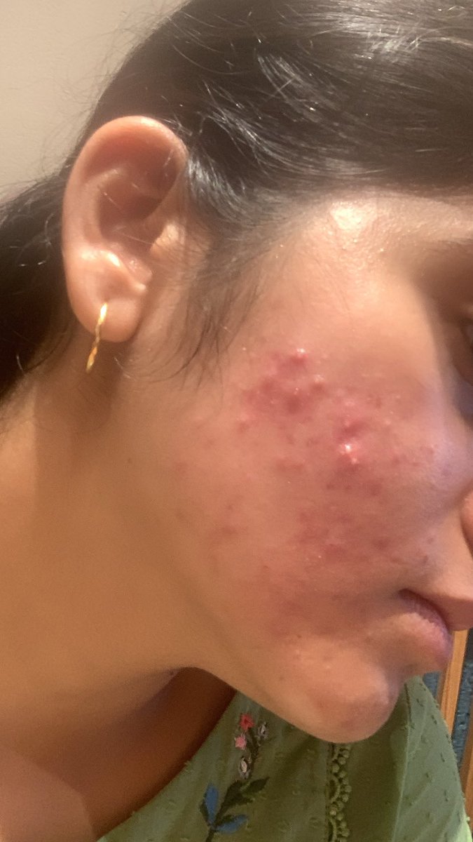 MANSAFAB's tweet image. I have struggled with acne, weight issues and underconfidence all my life.

In 2024, I decided to finally run my first marathon.

During this prep I lost ____ Kg and gained massive confidence.

Hi I’m final MBBS student and here is my story: