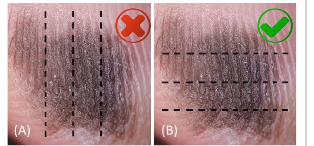 How to section a melanocytic lesion?
Macroscopy matters and can influence our diagnosis.

For more tips, see the Guideline from
the Brazilian Society of Pathology 👇🏽👇🏽

#path #dermpath #melanoma #cancer #dermatology

surgexppathol.biomedcentral.com/articles/10.11…