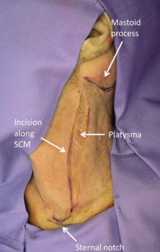 Trauma Surgery & Acute Care Open (TSACO) (@tsaco_aast) on Twitter photo Penetrating neck injury may be challenging as it has become more nonoperative and because trauma surgeons infrequently operate in the neck.
<a href="/LossLindsey/">Lindsey Loss, MD</a> et al explain everything you need to know in a comprehensive review in TSACO:
➡️ bit.ly/3QTZzr5 Penetrating neck injury may be challenging as it has become more nonoperative and because trauma surgeons infrequently operate in the neck.
<a href="/LossLindsey/">Lindsey Loss, MD</a> et al explain everything you need to know in a comprehensive review in TSACO:
➡️ bit.ly/3QTZzr5