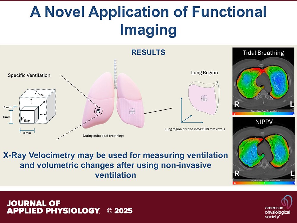japplphysiol's tweet photo. Research Article by D Karmali et al. (@univmiami) Regional #lungvolume changes with noninvasive positive pressure #ventilation in healthy adults 🫁 #NIPPV
🔒https://t.co/9kgpVHJ3Nc https://t.co/Tz3YTfETjZ