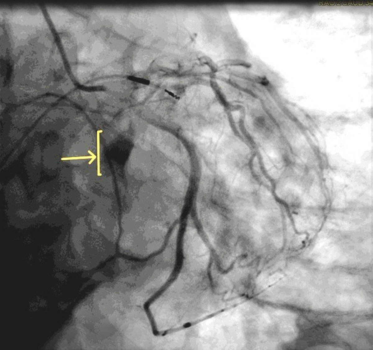 A Case Report of an Interventricular Septal Hematoma Presenting as a STEMI Post-Pacemaker Implantation 
<a href="/ahmadqureshi267/">Ahmad Qureshi</a> 
heartrhythmcasereports.com/article/S2214-…