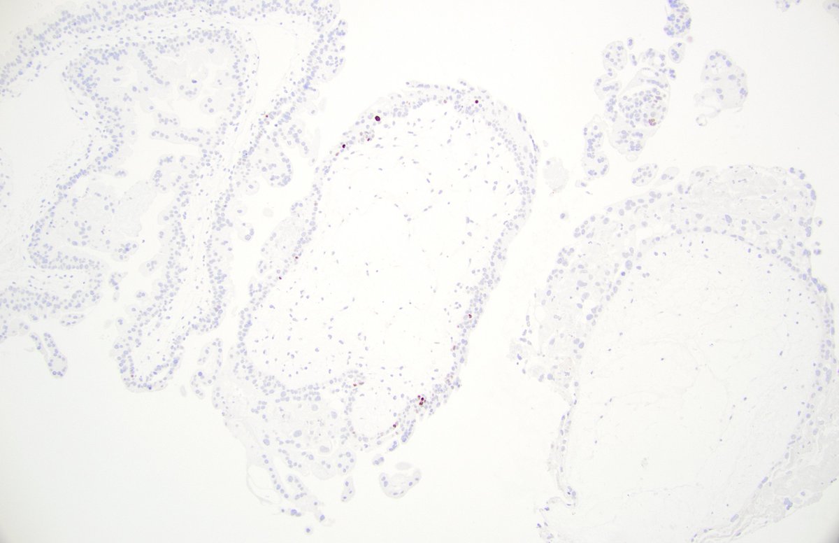 dgbrackett's tweet photo. Example of villi with negative stromal cells but few/rare positive cytotrophoblast
Interested to see how many people have seen this discordant pattern! (3/3)
#obpath #placentapath
@leon_metlay @JasmineSteeleMD https://t.co/7YdJDFwsPo