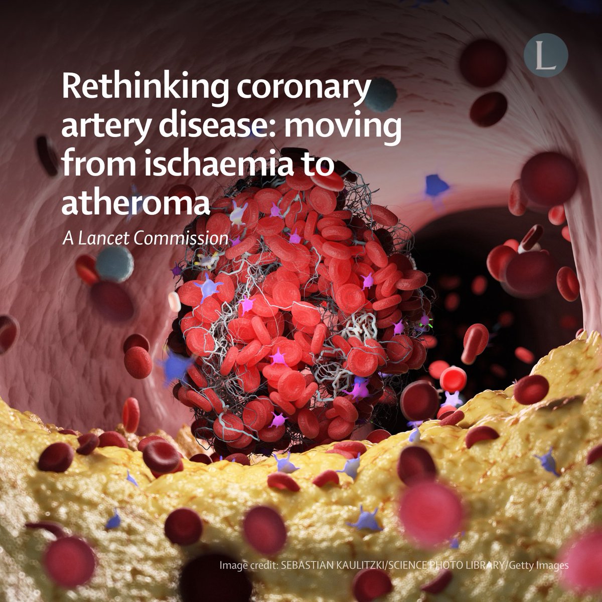 🆕 Coronary artery disease (CAD) remains a leading cause of global morbidity &amp; mortality.

A Lancet Commission redefines CAD, emphasising early detection, risk factor management, &amp; a comprehensive approach to prevention throughout the life course: hubs.li/Q03f35QX0 #ACC25