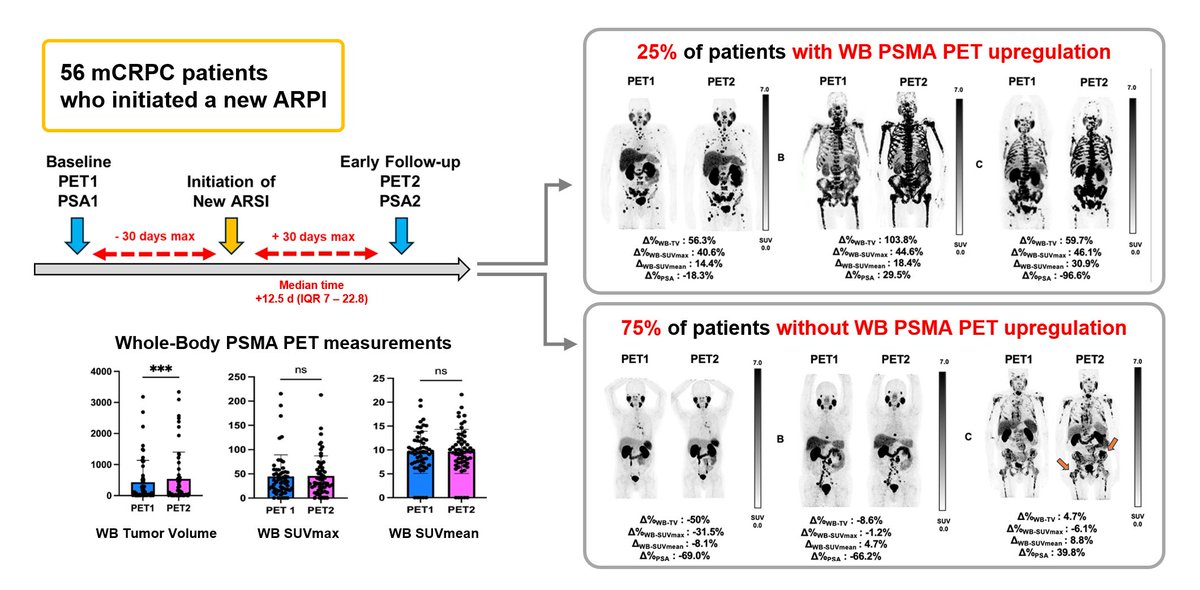 Jeremie Calais (@calaisjeremie) on Twitter photo PSMA and AR directed therapies: additive or synergistic effect ? ➡️56 mCRPC patients initiated a new ARPI and had a PSMA PET scan early after (≤30 days): PSMA upregulation observed in the whole body tumor burden in 25% of the patients. <a href="/UnterrainerLena/">LenaUnterrainer</a>
link.springer.com/article/10.100… PSMA and AR directed therapies: additive or synergistic effect ? ➡️56 mCRPC patients initiated a new ARPI and had a PSMA PET scan early after (≤30 days): PSMA upregulation observed in the whole body tumor burden in 25% of the patients. <a href="/UnterrainerLena/">LenaUnterrainer</a>
link.springer.com/article/10.100…