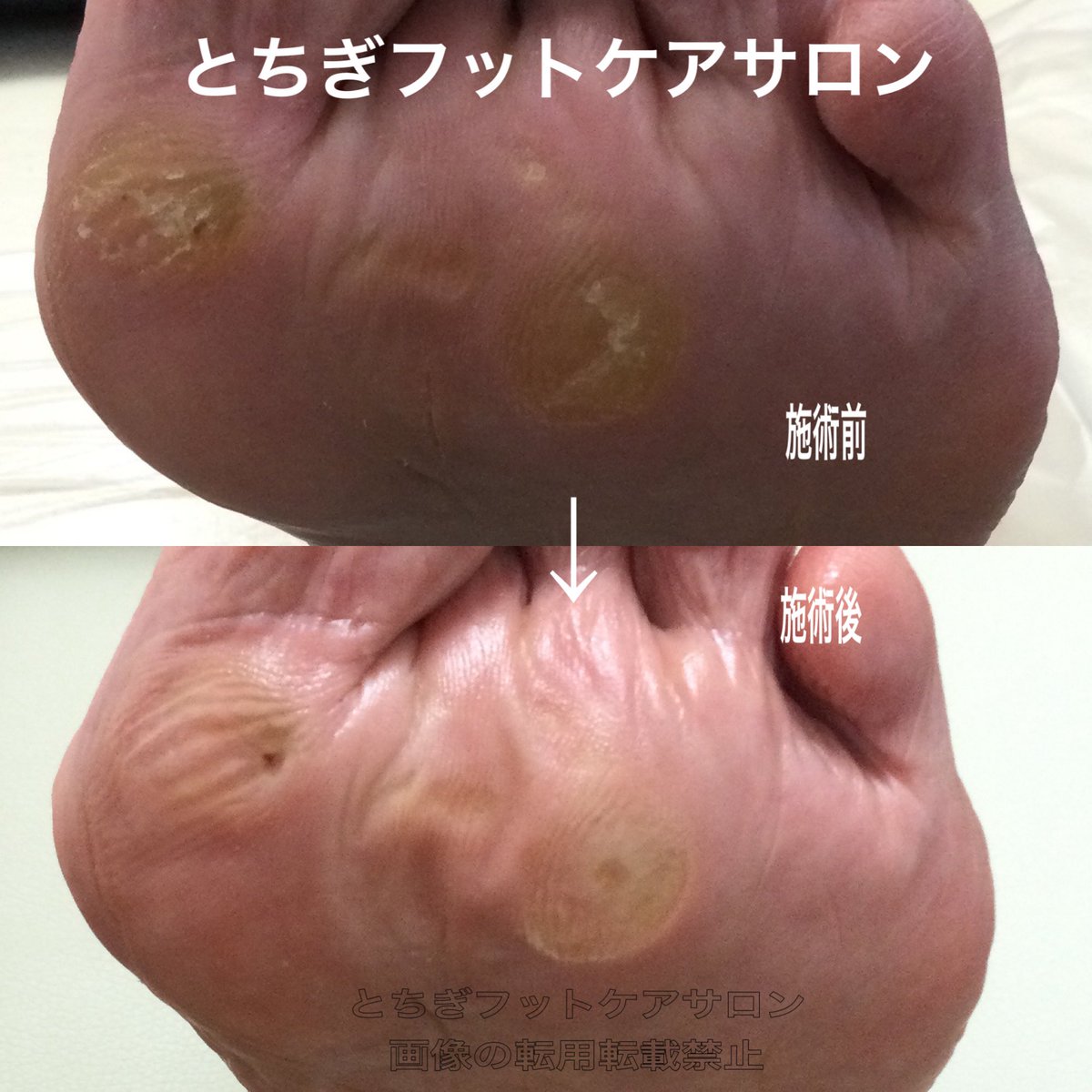 とちぎフットケアサロン-茂木有紀 (@fuss04tochigi) / Posts / X