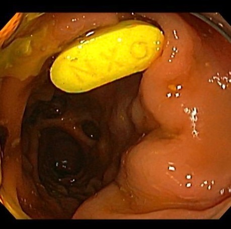 sentigastro's tweet image. Seen on colonoscopy
Can you guess the name of the drug and its content ?
#GITWITTER #MedEd #colonoscopy