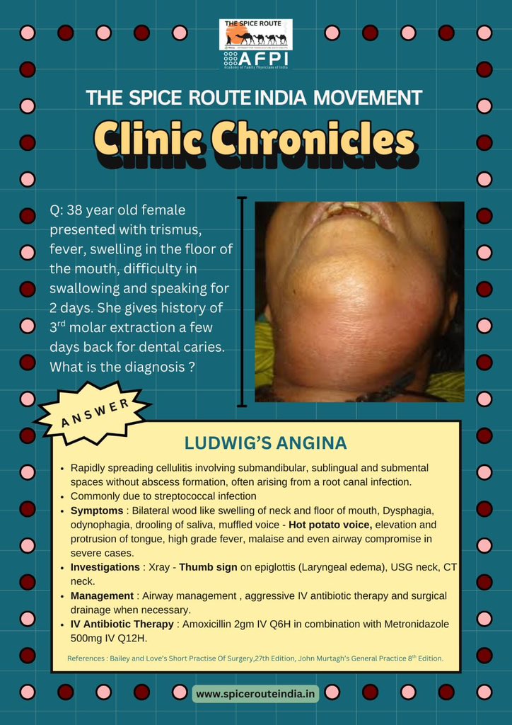 The Spice Route India Movement brings to you a new topic in the series of Clinic Chronicles!

A concise summary of Ludwig's Angina is presented here for the last minute revision!!

#clinicchronicles #spicerouteindia #proudtobeafamilyphysician #happylearning