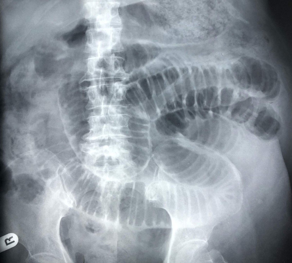 A 68 year old woman presents with abdominal pain and constipation for 3 days

An X-ray is taken - the supine film is shown here.  What does it show?

oslercommunity.com/s/preview/quiz…

#meded #medtwitter #tipsfornewdocs #FOAMed #CPDHome #CPDHomes #juniordocs