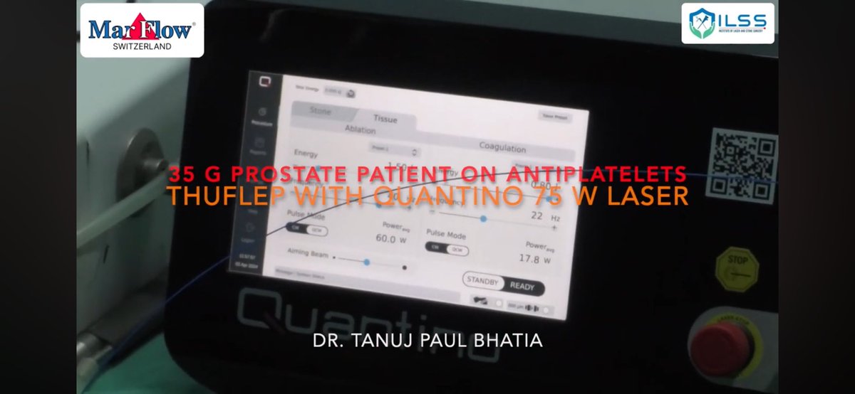 ThuFLEP LASER Prostate Surgery using Quantino 75W LASER youtu.be/nCw6dNNH_aE?si… via <a href="/YouTube/">YouTube</a> #ThuFLEP #LASERprostatesurgery