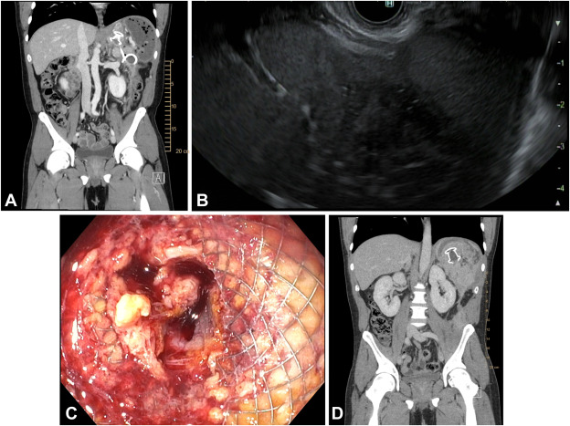 GIE (@gie_journal) on Twitter photo At the Focal Point, Canakis and Baron showcase "EUS-guided transmural drainage of a splenic abscess." giejournal.org/article/S0016-…
#GITwitter
<a href="/AndrewCanakis/">Andrew Canakis</a> At the Focal Point, Canakis and Baron showcase "EUS-guided transmural drainage of a splenic abscess." giejournal.org/article/S0016-…
#GITwitter
<a href="/AndrewCanakis/">Andrew Canakis</a>