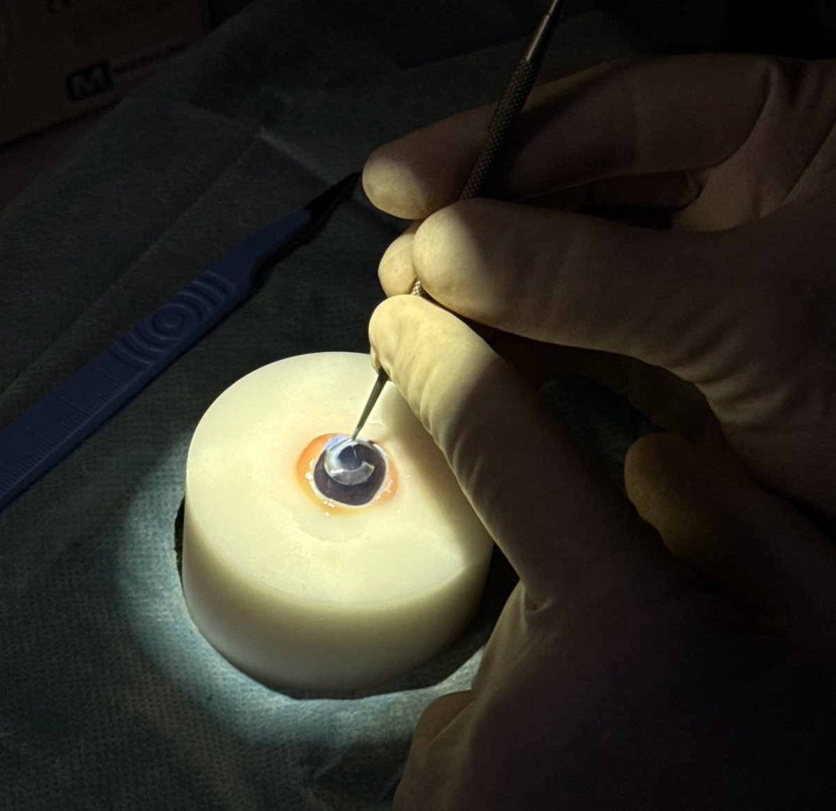 FLAAKAcademy's tweet photo. 🤔What is Micro-Tunneling in #FLAAK: After local anesthesia, a #femtosecond laser creates a microtunnel in the cornea for pigment, preserving the pupil. It closes naturally, with #eye drops for healing. Train with our academy!
#ophtalmology #science https://t.co/uaS9SJzTJy