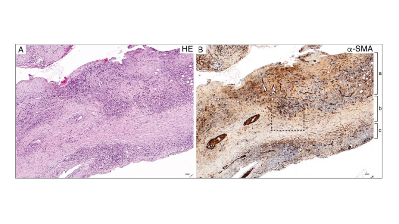 🔬研究成果🔎

脳神経内科学分野の中島章博助教と新潟大学大学院医歯学総合研究科の河内泉准教授らの研究グループは、厚生労働省指定難病・血管炎による脊椎肥厚性硬膜炎の新たな病態を発見－治療法に道－🧠
bri.niigata-u.ac.jp/research/resul…