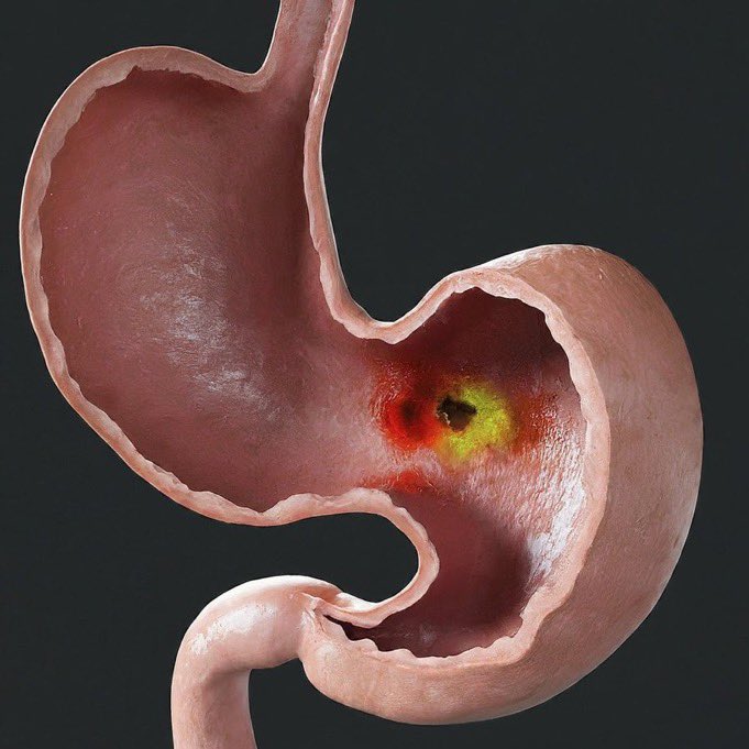 Many people think peptic ulcer is caused by spicy foods, stress, or skipping meals.

But that's not the full story 

Gonna break it down 👇🧵